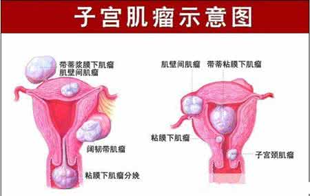 子宫肌瘤怎么治最好 子宫肌瘤不能吃什么
