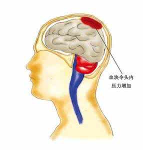 如何预防脑溢血 预防脑溢血很有效的药枕