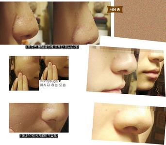 黑头粉刺怎么去除最好 怎么去黑头粉刺 去黑头粉刺注意事项