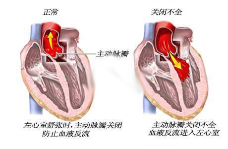 二尖瓣狭窄的治疗 二尖瓣狭窄 我们应该如何治疗二尖瓣狭窄