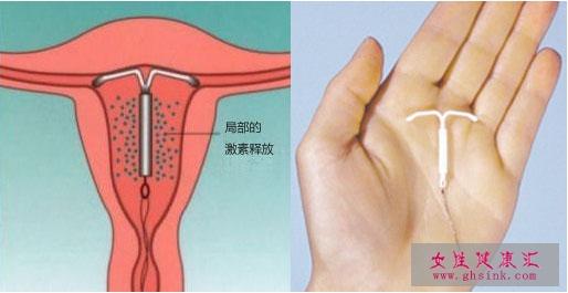 取节育环后注意事项 上节育环后注意事项 人流后可直接上节育环吗