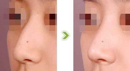驼峰鼻矫正后遗症 驼峰鼻矫正 矫正驼峰鼻还你秀美的鼻子