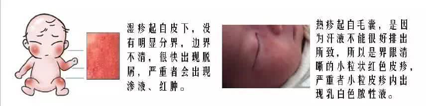 宝宝患干性湿疹的原因 宝宝干性湿疹如何治疗 宝宝患上干性湿疹的原因