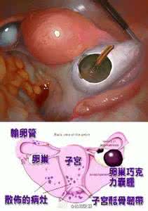 巧克力囊肿饮食 什么是巧克力囊肿 巧克力囊肿的饮食要点