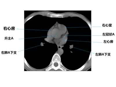 【PPT】结合解剖谈正常胸部CT – 影像PPT