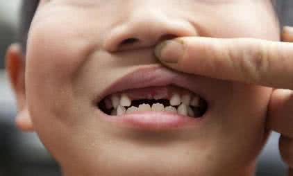 门牙缝隙大怎么办 宝宝门牙缝隙大为什么 孩子门牙缝宽怎么办