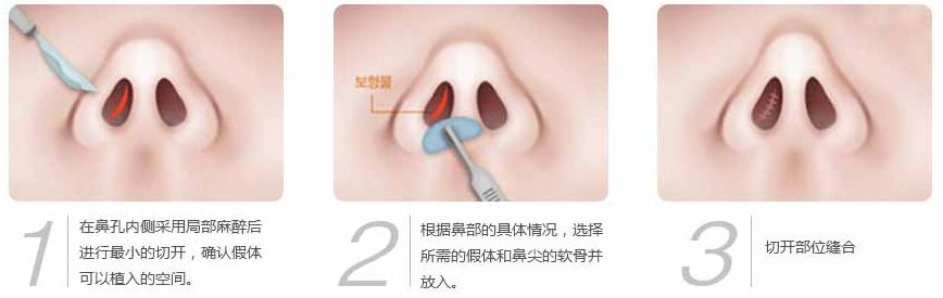 假体隆鼻后效果自然吗 假体隆鼻的效果 做假体隆鼻的效果自然吗