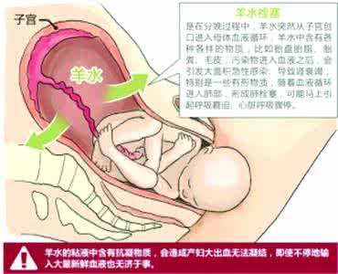 什么孕妇容易羊水栓塞 哪些孕妇容易患羊水栓塞