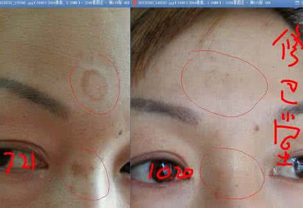 点痣后可以玩电脑吗 点痣后可以使用电脑吗