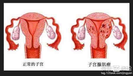 子宫腺肌症的原因 子宫腺肌症能怀孕吗 患上它的原因是什么