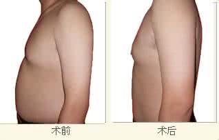 腹部吸脂后的注意事项 腹部吸脂后的注意事项 腹部吸脂注意事项有哪些
