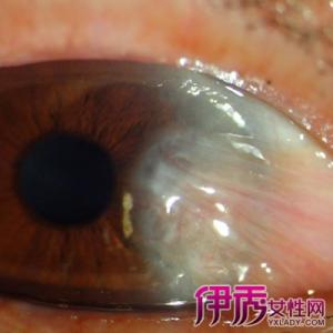 眼睛长胬肉的偏方大全 眼睛生胬肉2方