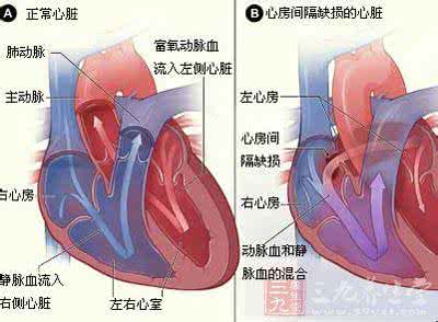 å¿èç ´æ´ 女孩心脏“破个洞” 10%先心患者为房间隔缺损