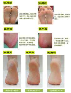 脚后跟皲裂 脚跟皲裂后的护理中西医各有妙招