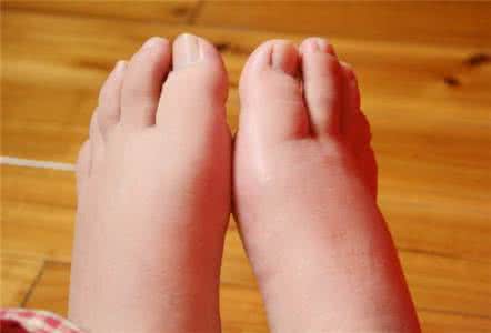 孕期浮肿是男孩女孩 孕期浮肿的原因