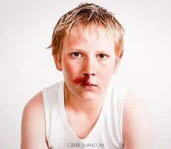 小孩流鼻血会是白血病 小孩流鼻血是白血病 小孩为什么会突然流鼻血