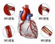 冠心病前期症状 冠心病的前期症状 冠心病的前期症状 冠心病吃什么比较好