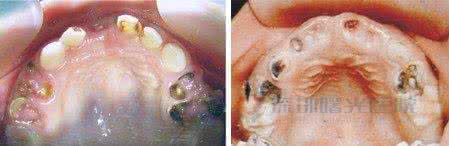 乳牙龋坏 乳牙龋坏要补吗？