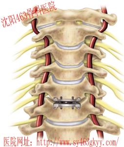 强直性脊髓炎症状 强直性脊髓炎 强直性脊髓炎的症状