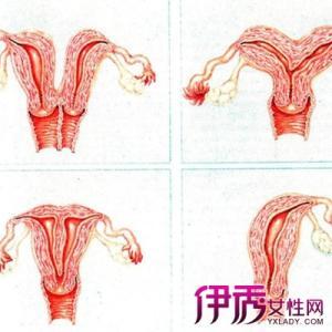 双子宫有什么危害 双子宫的危害 这种女人身上竟会有两个子宫