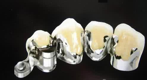 钴铬烤瓷牙价格表 钴铬烤瓷牙价格 钴铬烤瓷牙