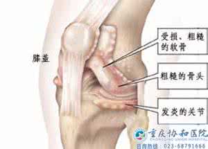 腰椎颈椎 【健康指南·资讯·常识】颈椎、腰椎、膝关节骨质增生(骨刺)都有哪些症状??