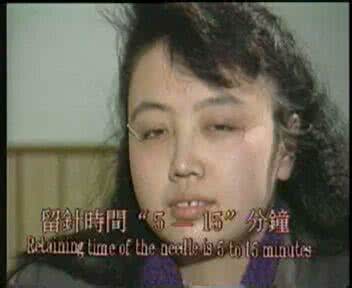 彭静山：针刺面瘫十法