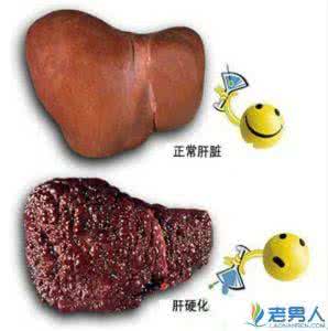 肝硬化最佳治疗方法 肝硬化能治好吗 肝硬化治疗方法