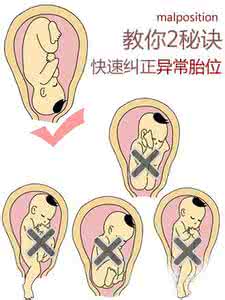 胎位异常 怎么预防胎位异常