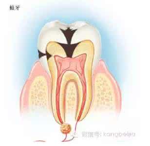 智齿蛀牙一定要拔吗 蛀牙一定要拔除吗？这8类人群拔牙须慎重