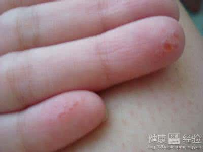 手指头划伤感染艾滋病 手指头划伤感染艾滋病 划破手会感染艾滋病吗?
