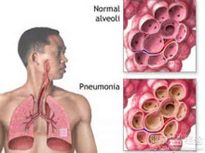 肺炎有什么症状表现 肺炎有什么症状表现 肺炎患者都有哪些症状表现