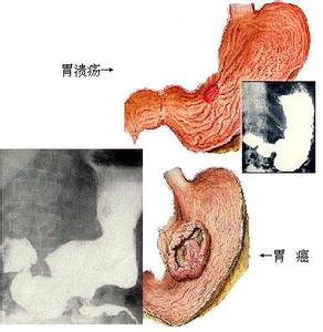 胃癌的早期症状及表现 胃癌的早期症状及表现 胃癌的早期症状 这些表现就是胃癌