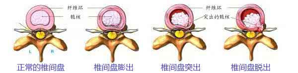 抑郁症的常见认知误区 腰椎间盘突出症的15个认知误区