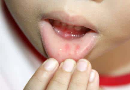 手足口病的症状图片 手足口病的症状