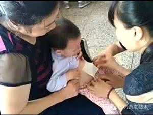 小儿腹泻中药 中药贴敷治疗小儿腹泻——医生专访