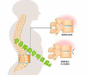 治骨质增生最佳方法 预防骨质增生 五个方法有效