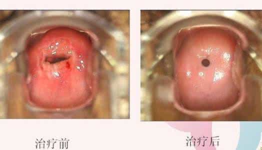 宫颈炎最佳治疗方法 宫颈炎治疗方法 中药治宫颈炎效果好