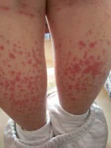 小儿过敏性紫癜症状 小儿过敏性紫癜 症状有哪些