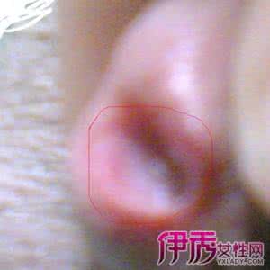 男性尿道炎吃什么药 女性尿道炎 尿道炎 男性