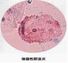 外阴炎临床有哪些特征 外阴炎临床有哪些特征 外阴炎有哪些特征？