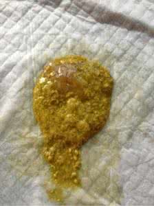 新生儿大便有奶瓣图片 新生儿大便有颗粒奶瓣怎么办