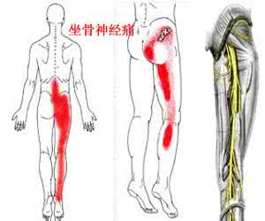 坐骨神经痛治疗方法 治疗坐骨神经痛有哪些方法