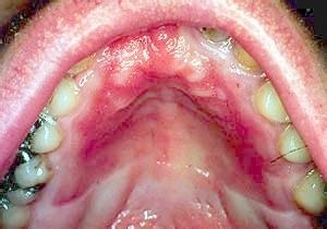 治疗口腔扁平苔藓偏方 双地苔藓饮治疗单纯型口腔扁平苔藓