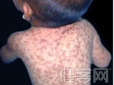 北京京瑞大厦 京疾控中心回应“北京某大厦一半人得麻疹”