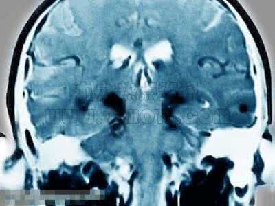 中国帕金森有望根治 帕金森患者有望重获新生