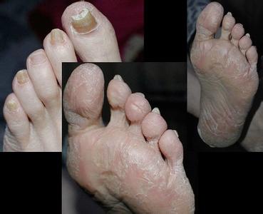 脂肪瘤最新治疗方法 脂肪瘤最新治疗方法 牛皮癣最新治疗方法 治牛皮癣用这方法好