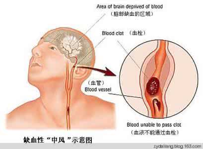 治疗脑血栓最有效的药 脑血栓能治好么 如何有效治疗脑血栓