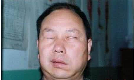 综漫黑暗本丸面瘫 面瘫扶正丸治疗周围性面神经麻痹的临床研究