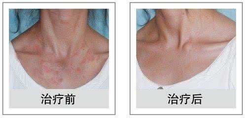 荨麻疹临床表现 荨麻疹临床表现 荨麻疹的几种常见临床类型